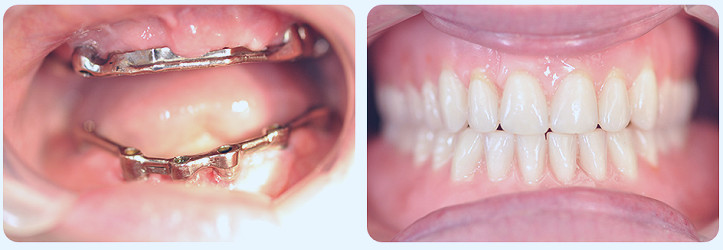 Implant Supported Denture